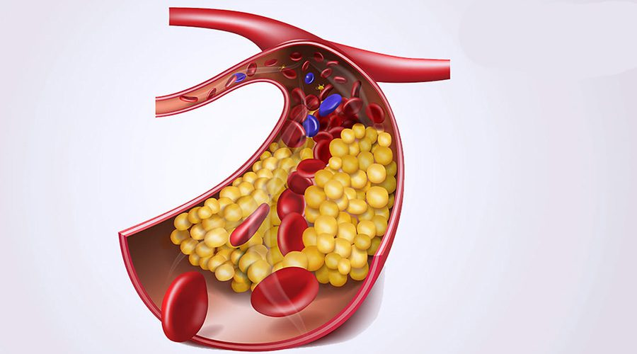 高脂血症的疾病概述与定义