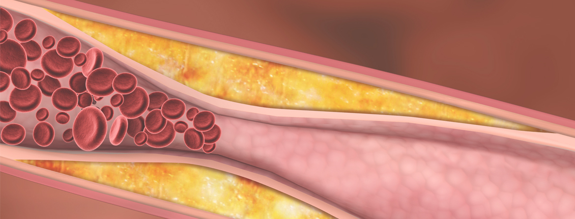 高脂血症的临床表现与症状