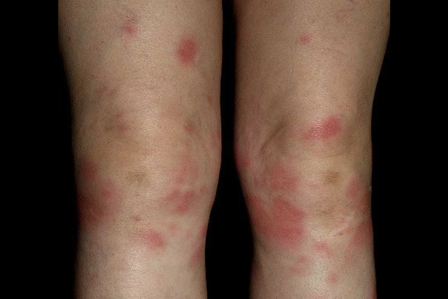 结节病的疾病概述与定义