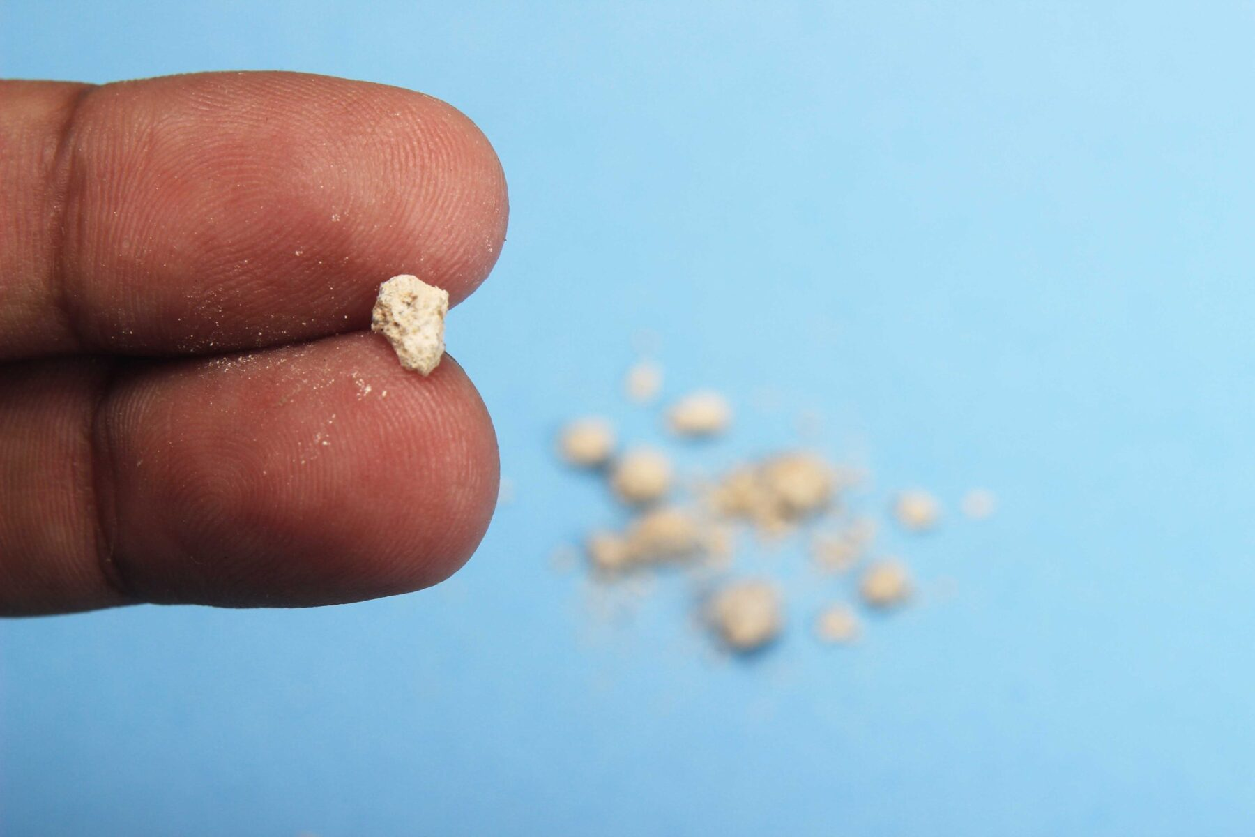 肾结石的疾病概述与定义