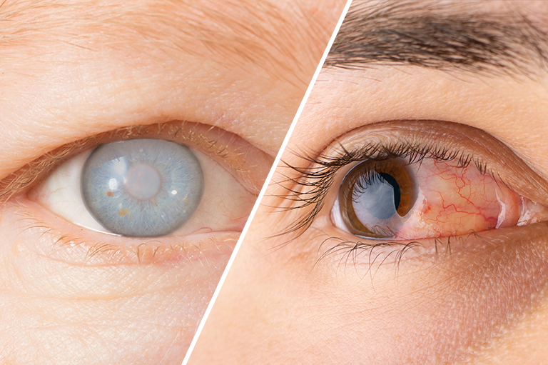 白内障的病理生理机制