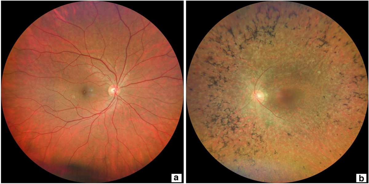视网膜色素变性的病理生理机制