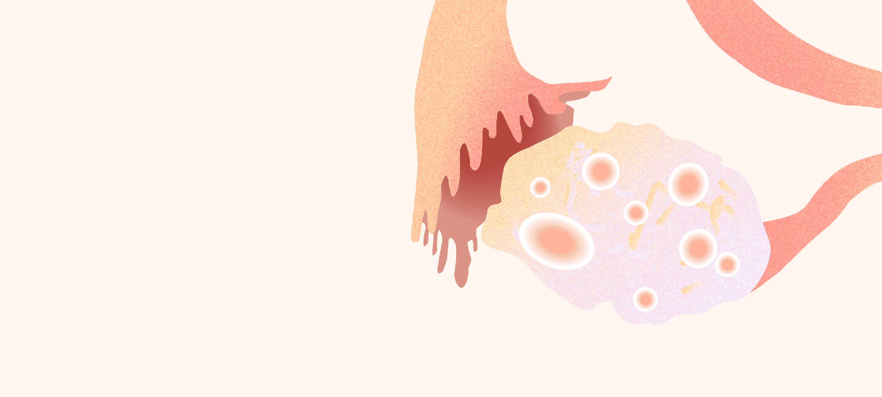 多囊卵巢综合征的病理生理机制