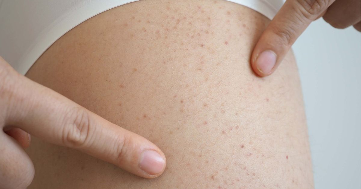 血小板减少症的治疗性饮食干预