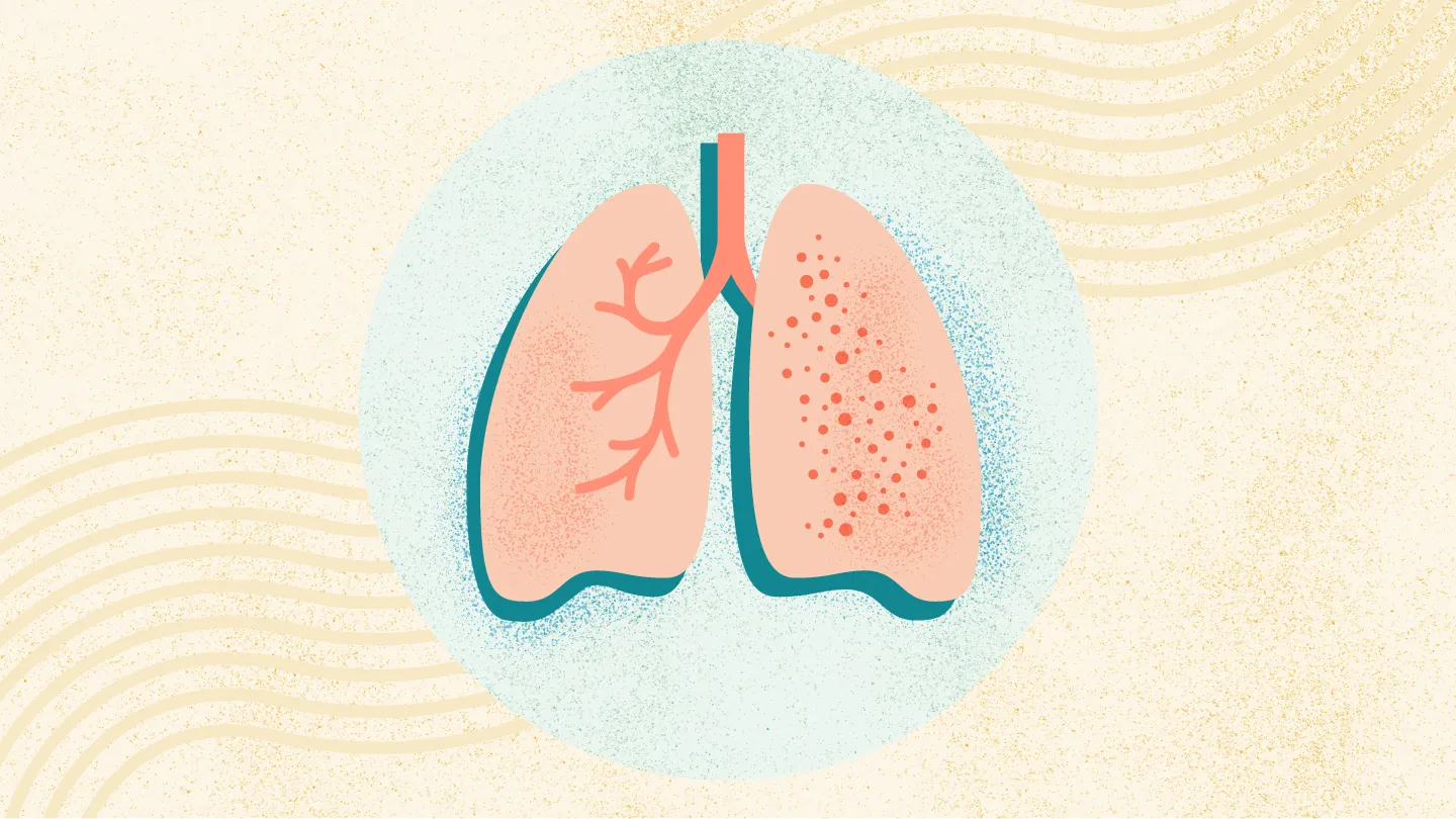 结核病的治疗与监测：PPD/IGRA报告、痰菌检查解读与规范化、足量抗结核治疗