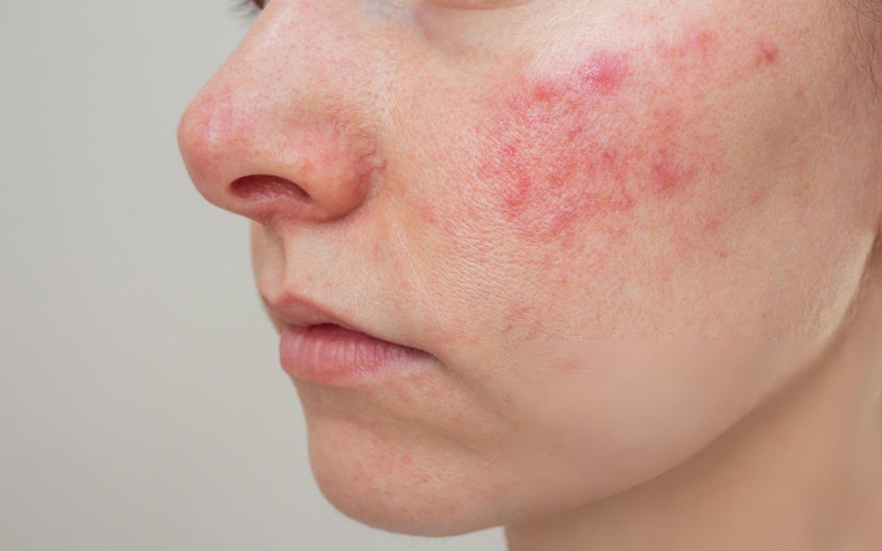 系统性红斑狼疮的治疗性饮食干预