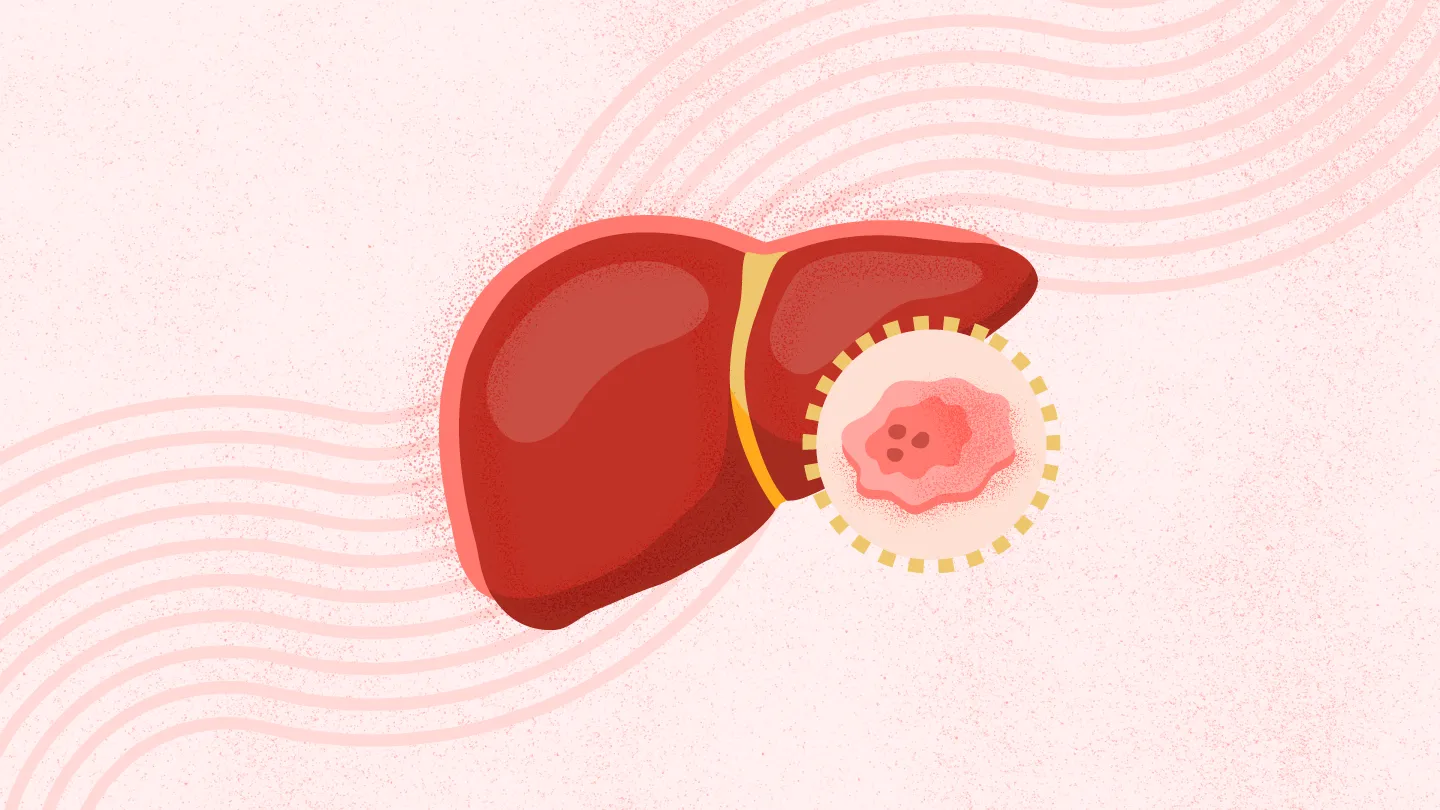 肝癌的营养评估方法