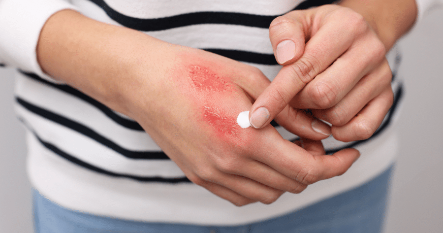 促进愈合：慢性伤口与压疮的PUSH评分、感染指标解读与清创、营养支持